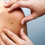 cancer_de_piel.jpg_1383191628